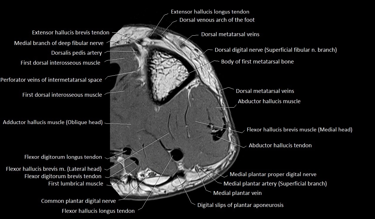 Great toe (hallux) axial microanatomy 3T MRI image 39.webp